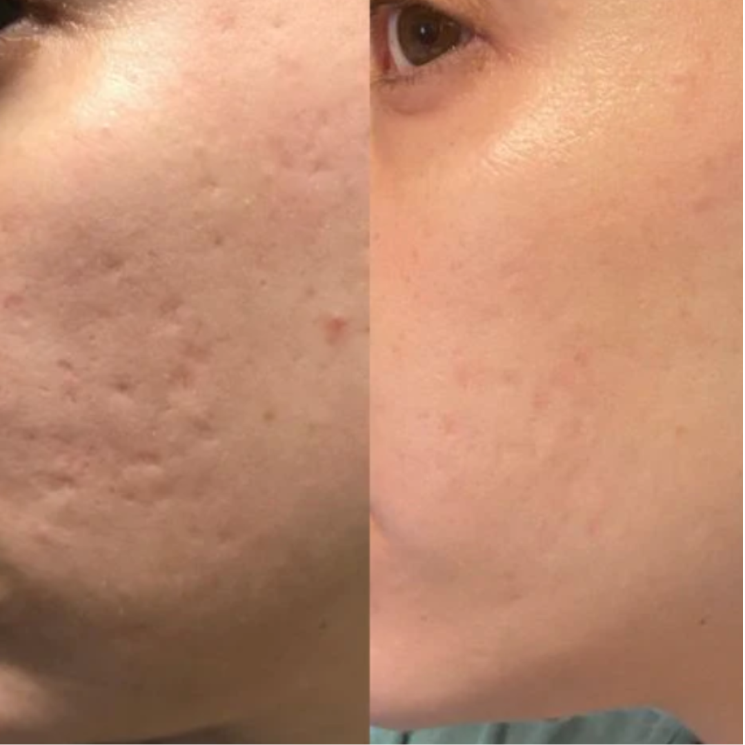 SkinRenew™ Silikonplåster